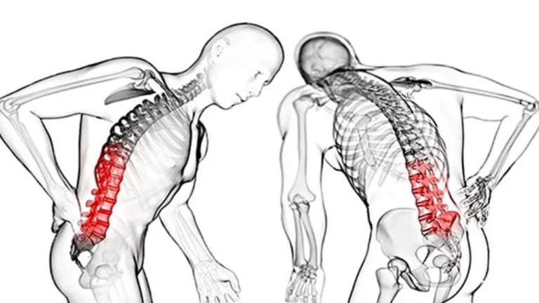 Ankilozan Spondilit Malulen Emeklilik Şartları 2026